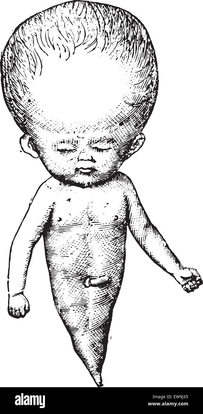 Monster ou syndrome sirenomelia Mermaid, vintage engraved illustration. Dictionnaire de médecine habituelle par le Dr Labarthe - 1885. Illustration de Vecteur