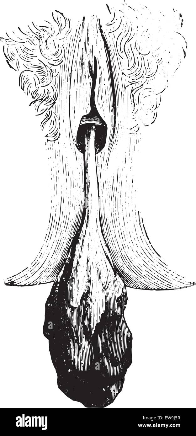 Polype cervical, vintage engraved illustration. Dictionnaire de médecine habituelle par le Dr Labarthe - 1885. Illustration de Vecteur