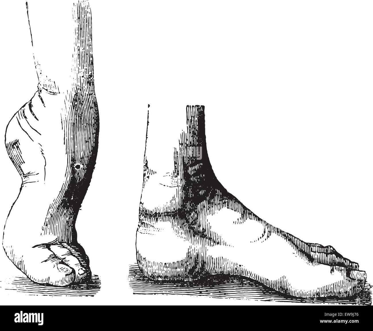 Un pied bot ou pied bot congénital ou talipes equinovarus (CTEV) equine avant et après l'opération, vintage engraved illustrat Illustration de Vecteur