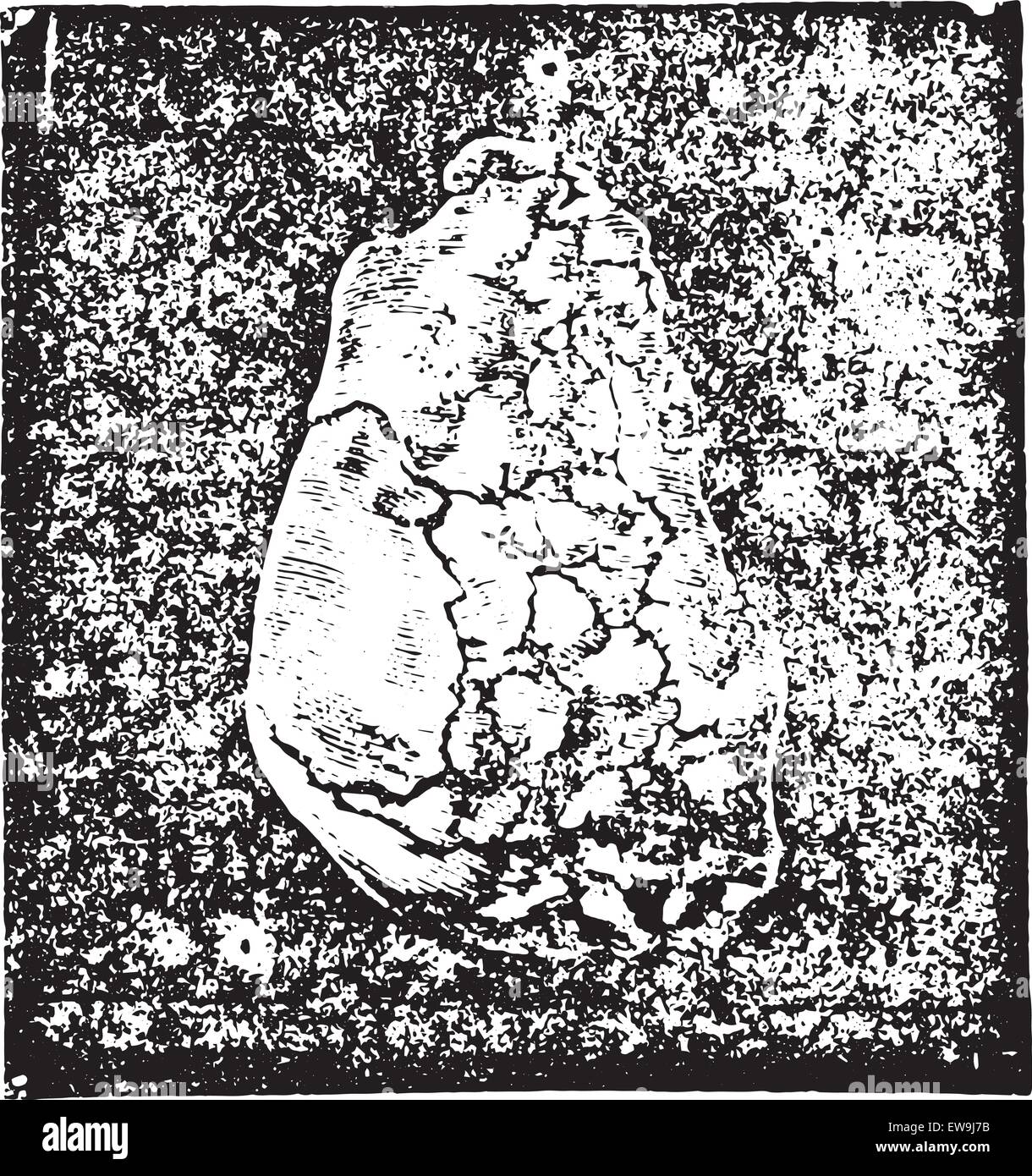 Calcul de l'urate de sodium dans enchaton la muqueuse vésicale et extraites par prerectale taille (dans le profil), vintage engraved mauvais Illustration de Vecteur