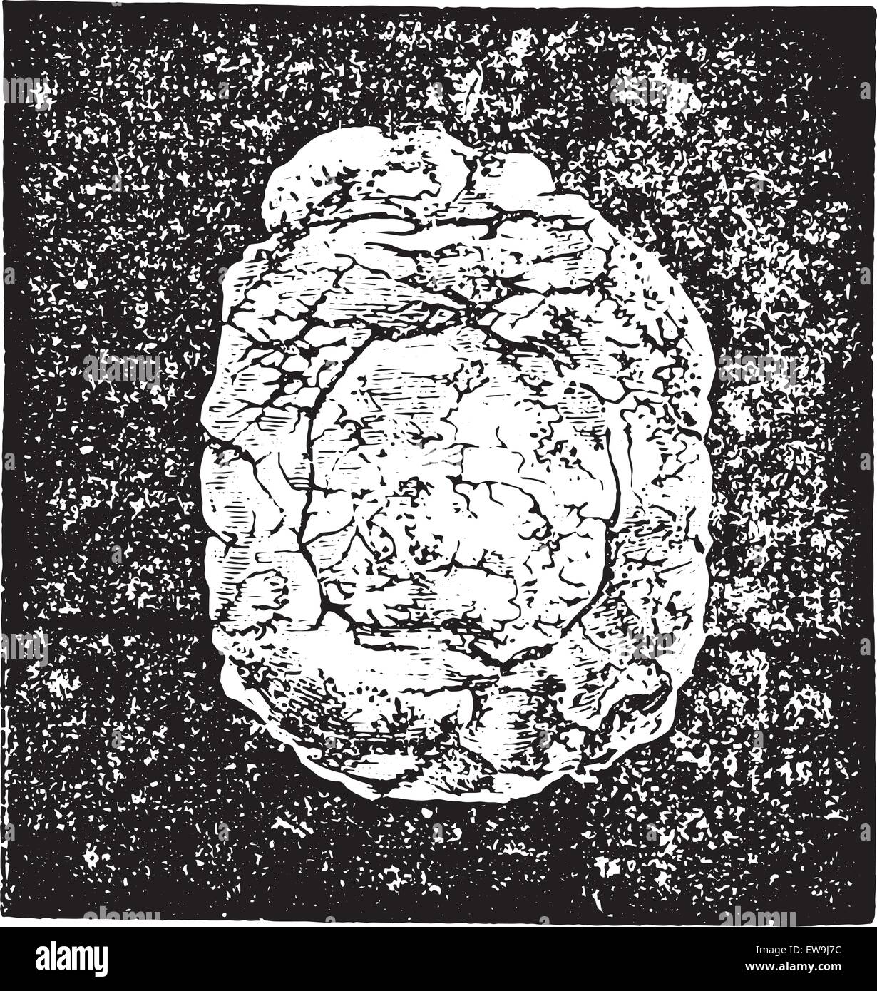 Calcul de l'urate de sodium dans enchaton la muqueuse vésicale et extraites par prerectale taille, vintage engraved illustration. Us Illustration de Vecteur