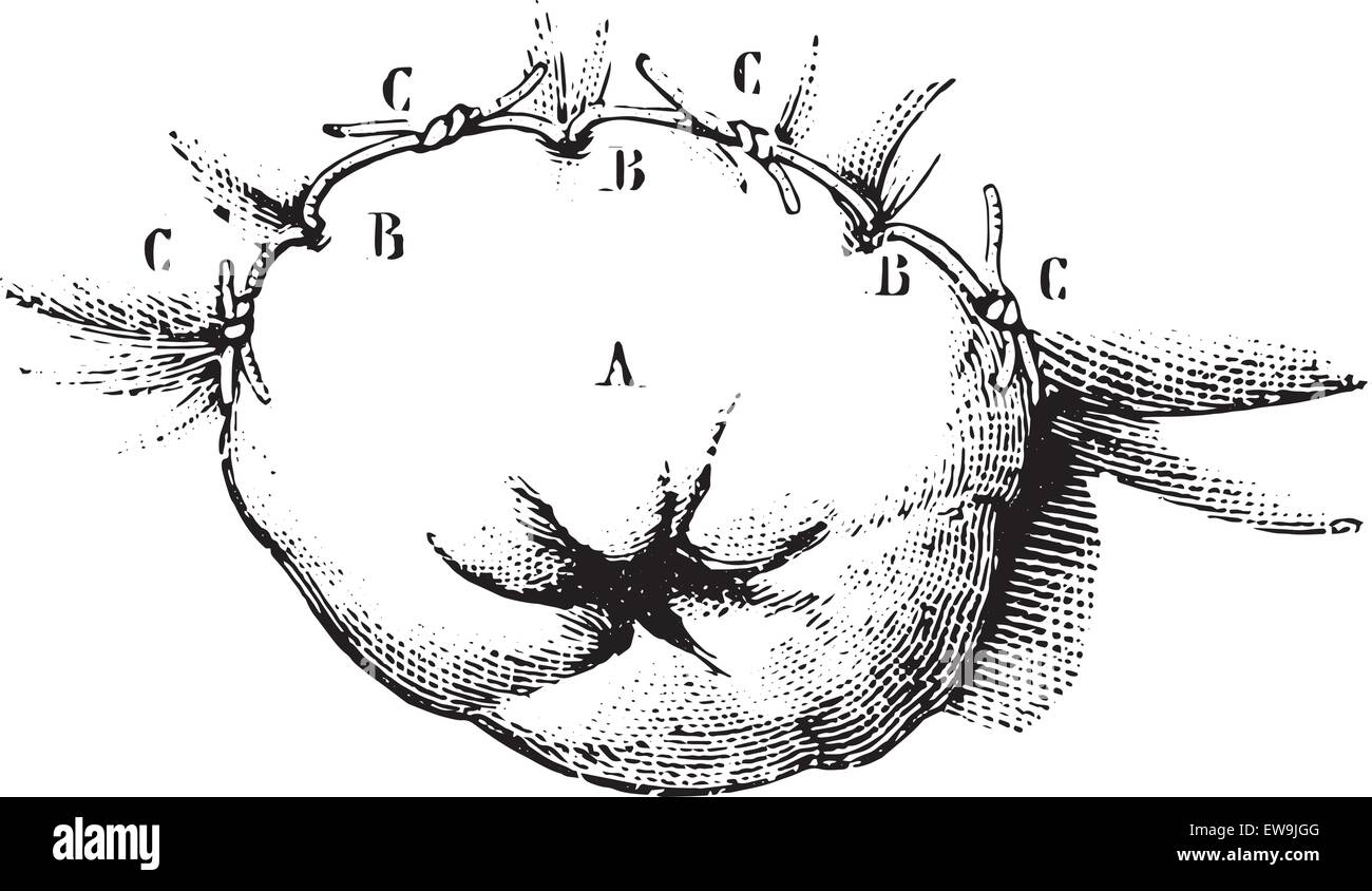 La disparition de l'extrémité inférieure du rectum à l'aide de la méthode des trompes Récamier, vintage engraved illustration. La médecine habituelle Dic Illustration de Vecteur