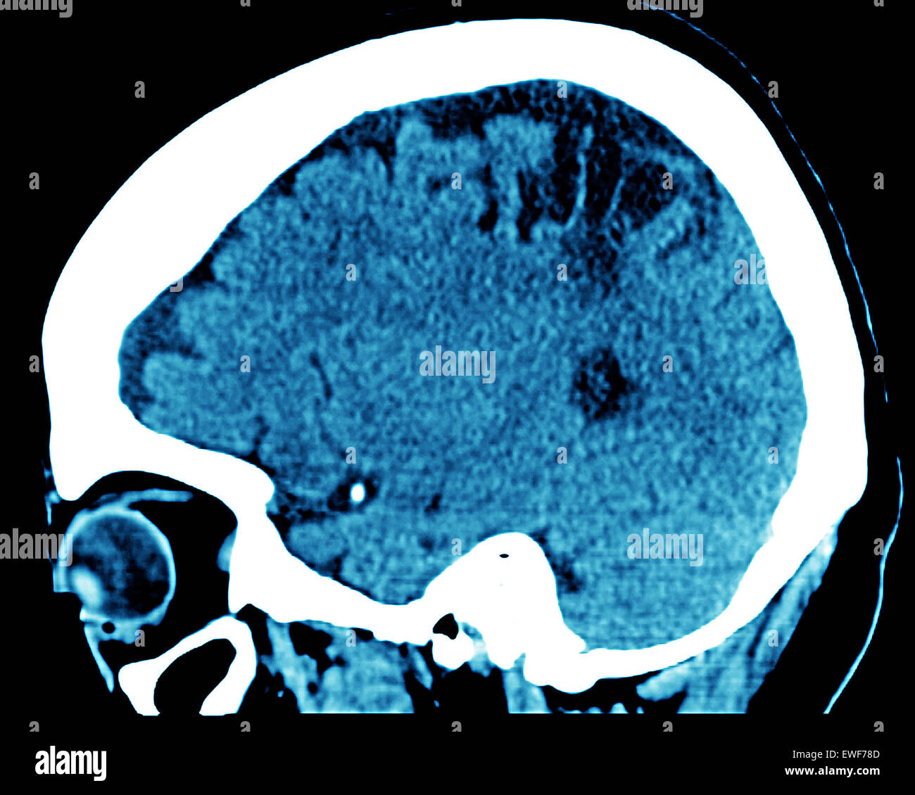 Une atrophie cérébrale, CT-SCAN Banque D'Images