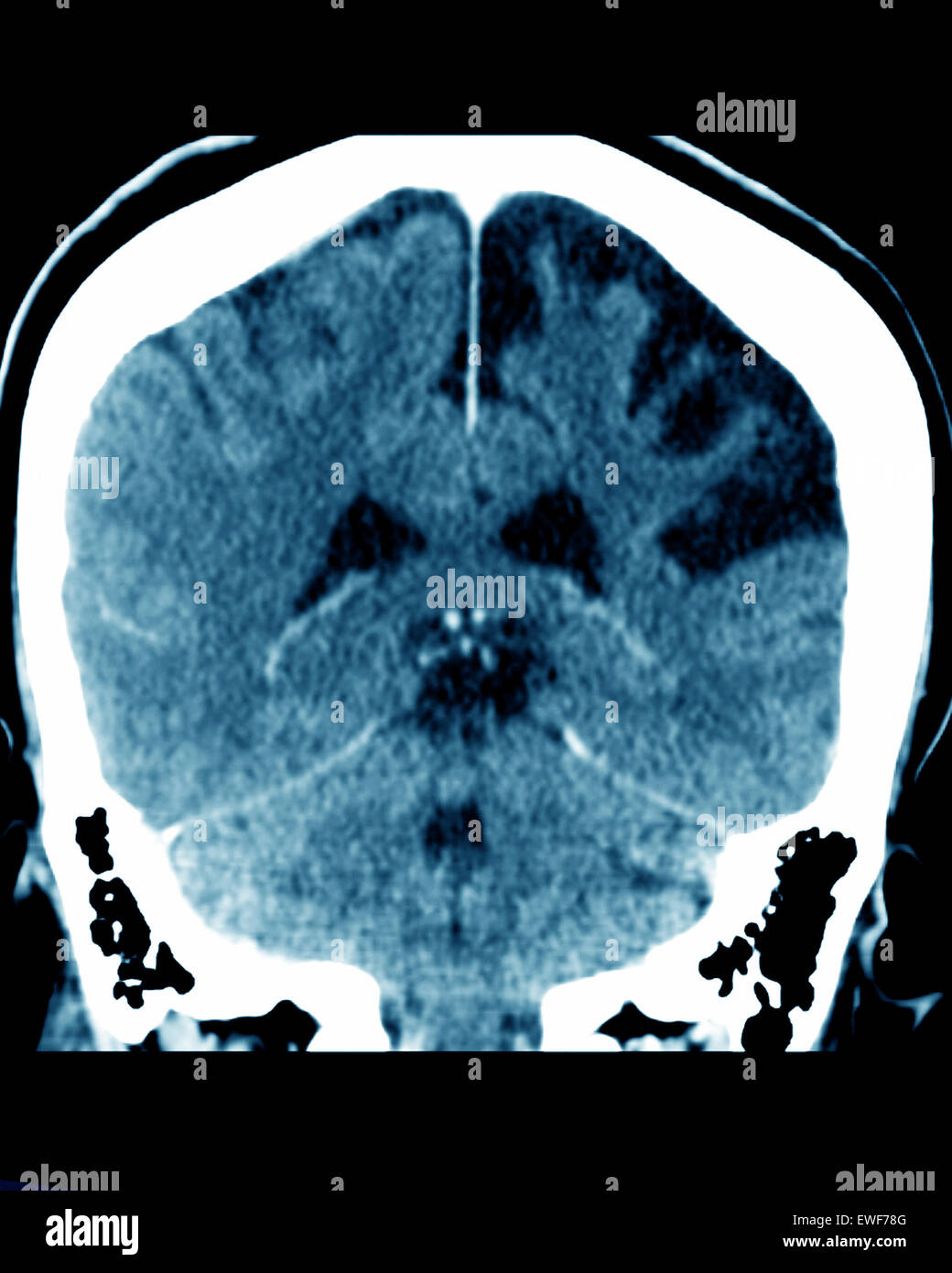 Une atrophie cérébrale, CT-SCAN Banque D'Images