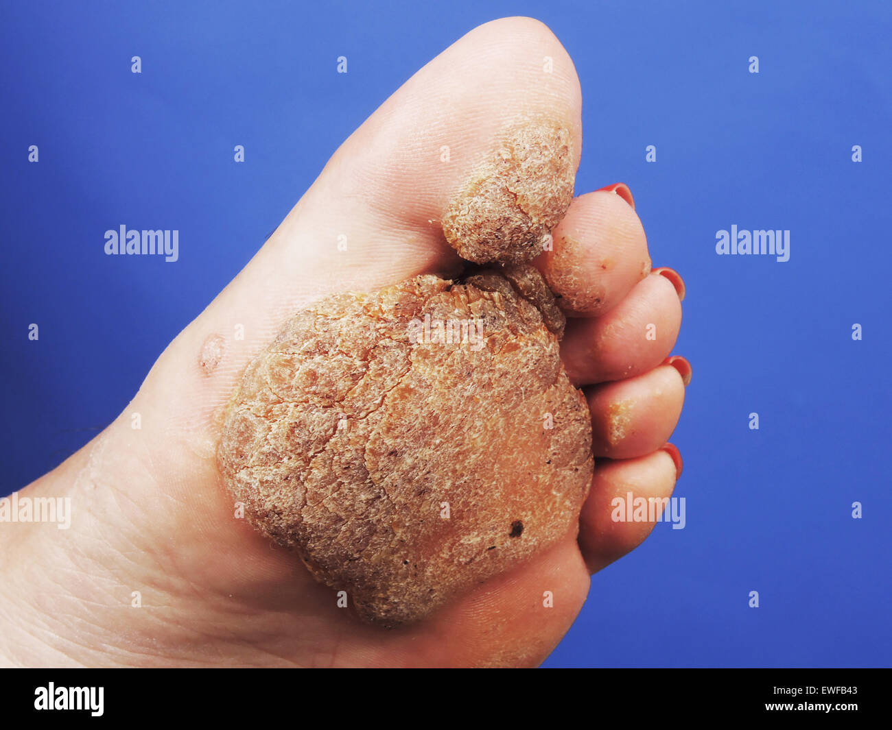 Verrue plantaire Banque de photographies et d’images à haute résolution Alamy