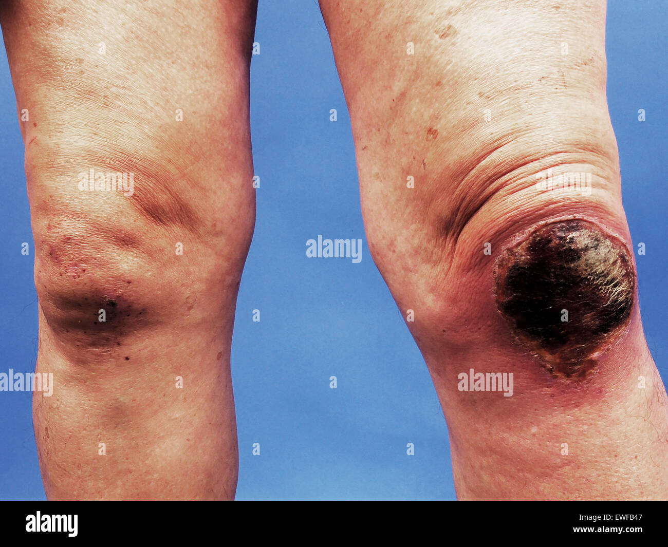 BRÛLER Banque D'Images