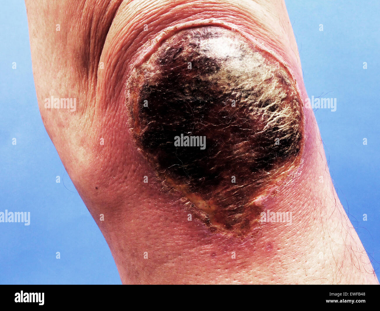 BRÛLER Banque D'Images