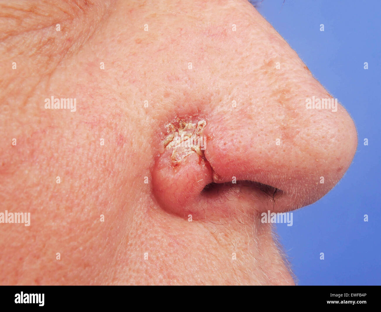 Cancer basocellulaire nez Banque de photographies et d’images à haute résolution Alamy