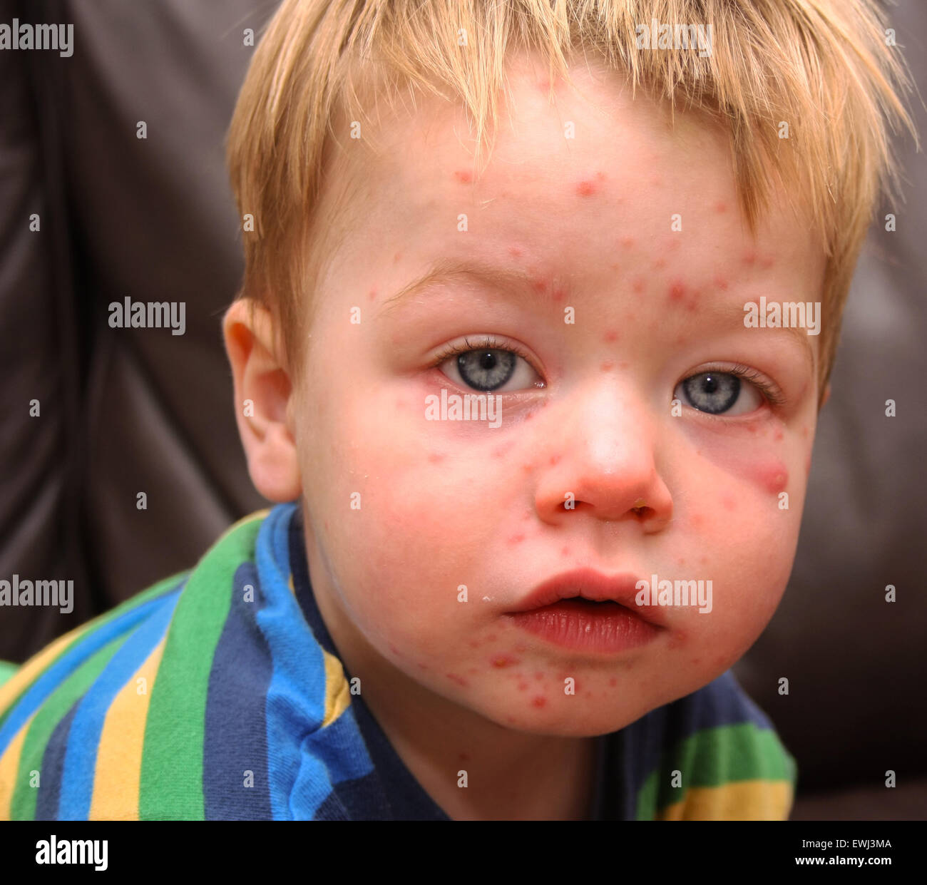 Enfant Avec La Varicelle Photo Stock Alamy