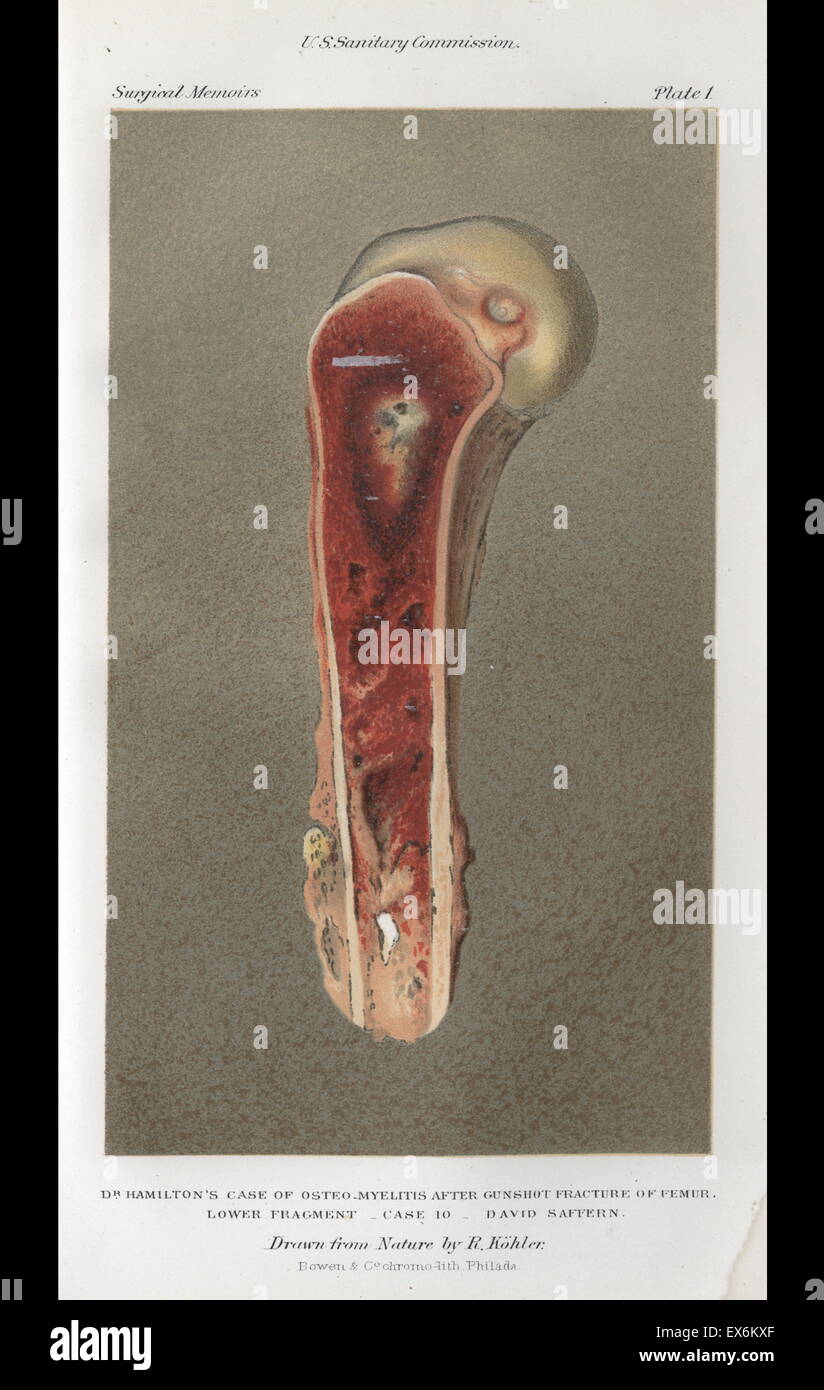 Dans l'infection blessure par balle, Mémoires de la guerre chirurgicale de la rébellion, Vol 1, 1870 Banque D'Images