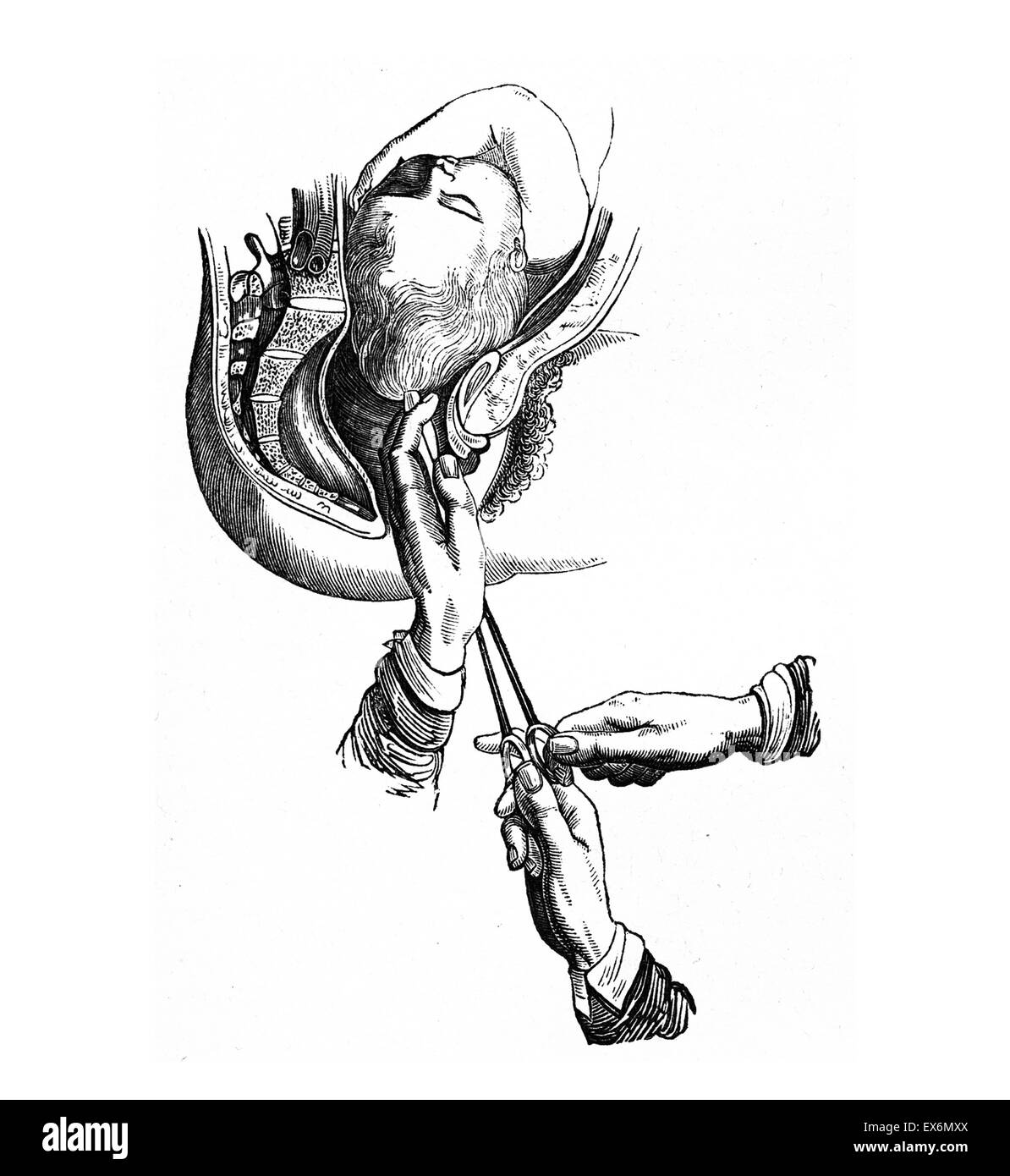 Une craniotomie. La perforation du crâne, l'enlèvement de matières, et d'extraction crânienne de la boîte crânienne. Banque D'Images