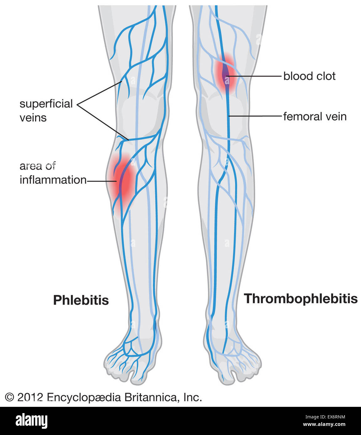 Thrombophlébite Banque D'Images