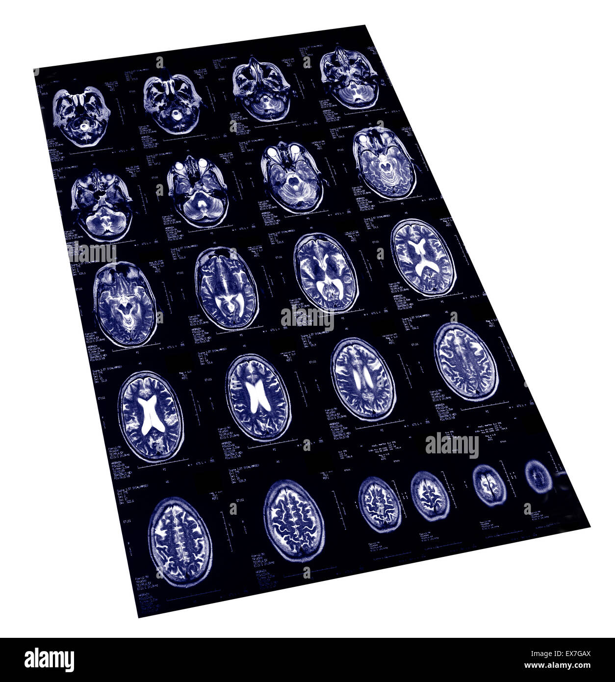 Irm normal du cerveau d'une femme âgée de 62 ans. Banque D'Images