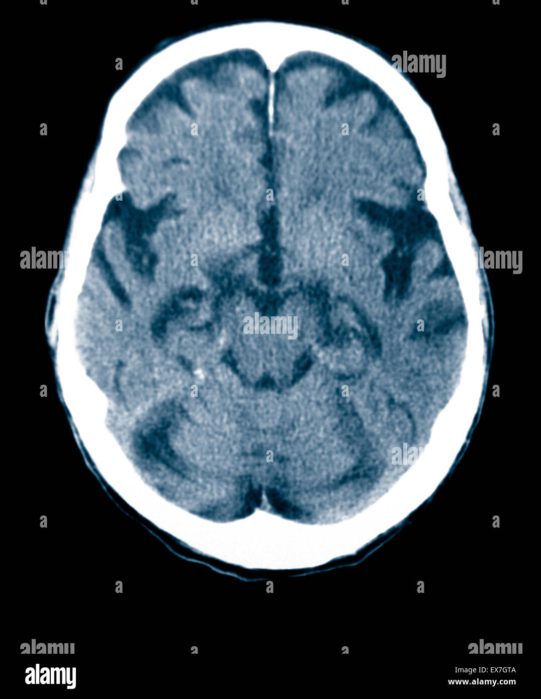 CT scan d'un vieil homme de 84 ans souffrant de la maladie d'Alzheimer. La TDM montre l'atrophie du cerveau. Banque D'Images
