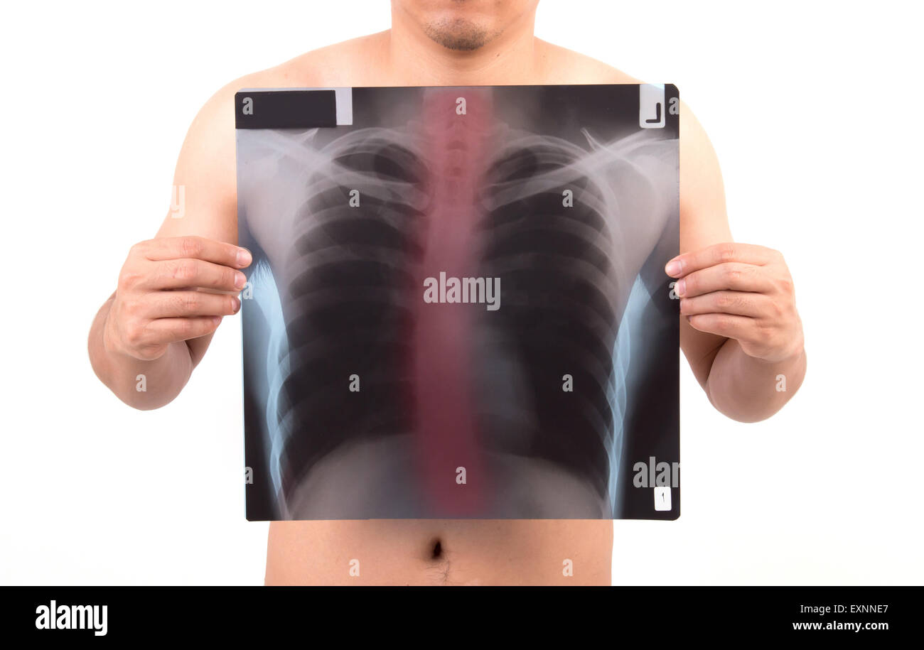 Unidentify personne montrant x-ray film avec étiquette rouge isolé sur fond blanc Banque D'Images