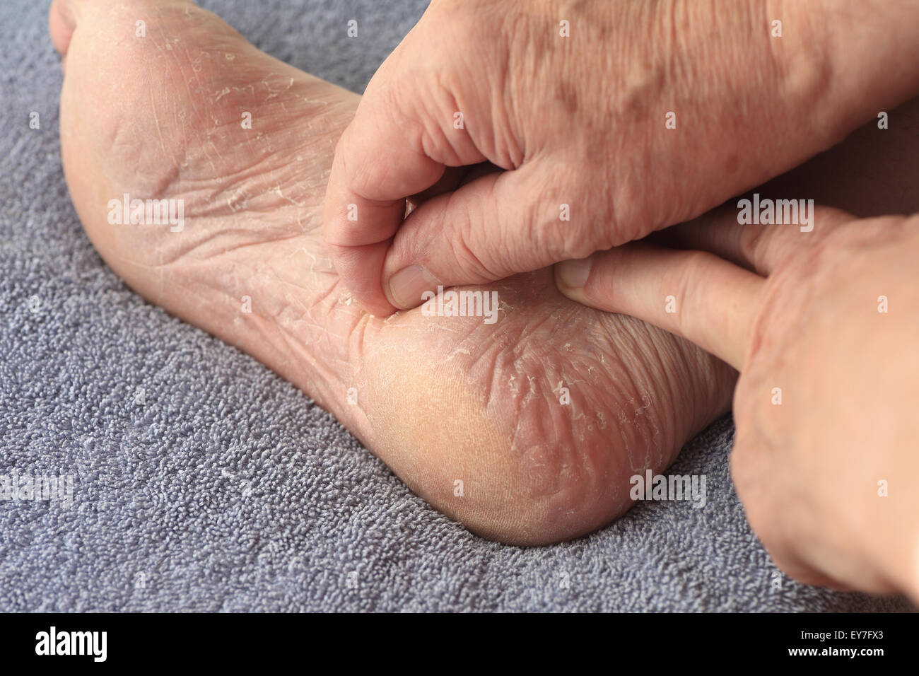 Un homme son peeling peau sèche de pied d'athlètes Banque D'Images