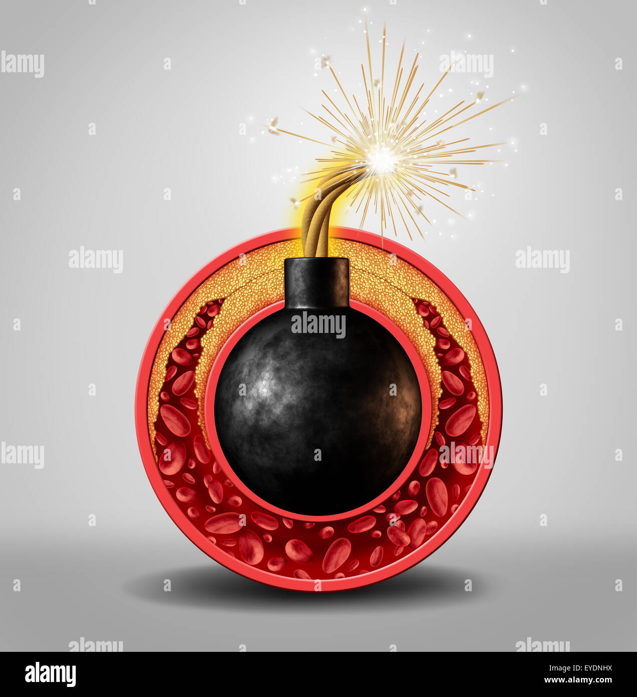 Bombe à retardement le cholestérol et la maladie coronarienne danger en tant que concept médical avec une bombe enflammée à l'intérieur d'une veine circulaire avec la formation progressive comme blocage des artères et l'athérosclérose comme une métaphore de l'accumulation de graisse les risques médicaux. Banque D'Images