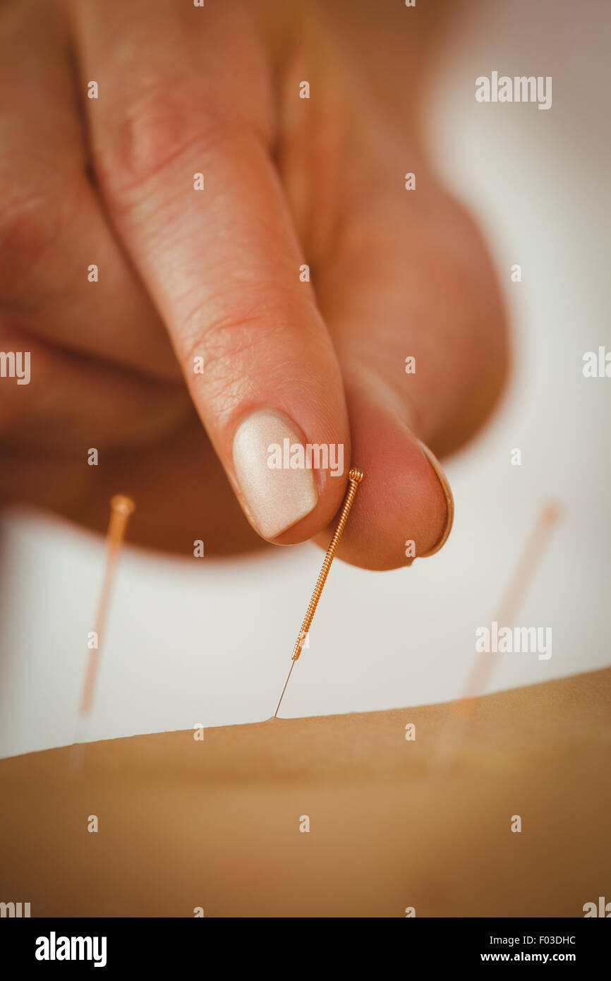 Young woman getting un traitement d'acupuncture Banque D'Images