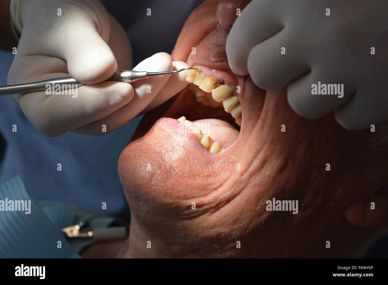 Les dents de l'homme contrôle dentiste, avant de déposer l'racine de l'incisive pourris. Banque D'Images