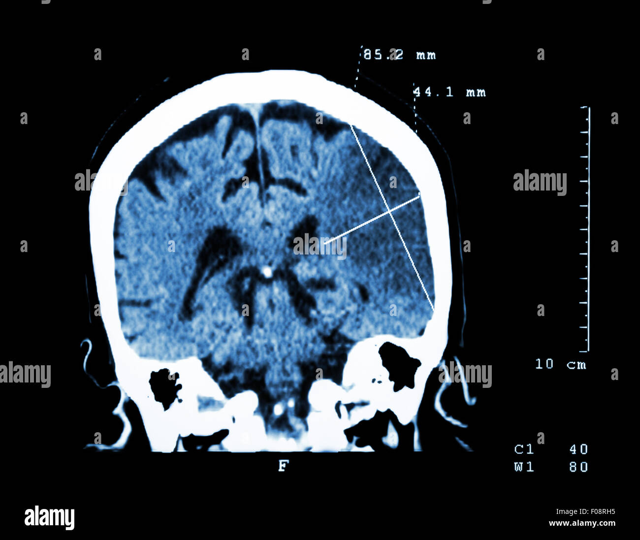 L'infarctus cérébral à l'hémisphère gauche ( ) de l'accident ischémique cérébral ( CT-scan du cerveau ) : La médecine et la science historique Banque D'Images
