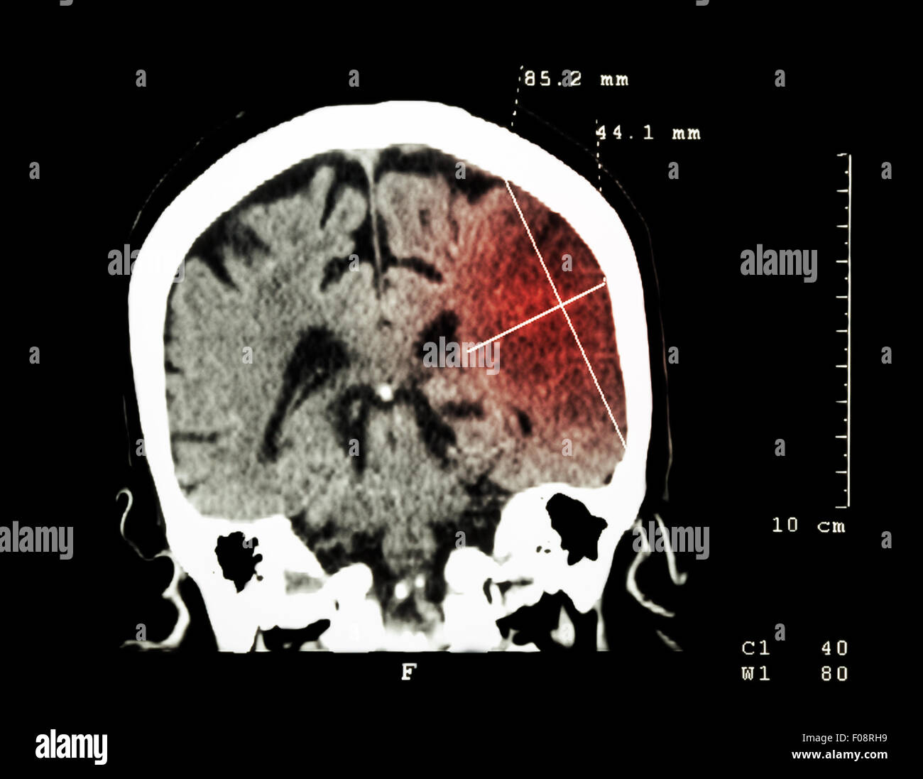 L'infarctus cérébral à l'hémisphère gauche ( ) de l'accident ischémique cérébral ( CT-scan du cerveau ) : La médecine et la science historique Banque D'Images
