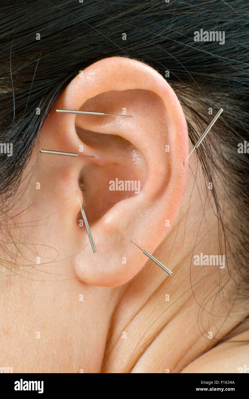 La thérapie d'acupuncture sur l'oreillette, très verticale la photo en gros Banque D'Images