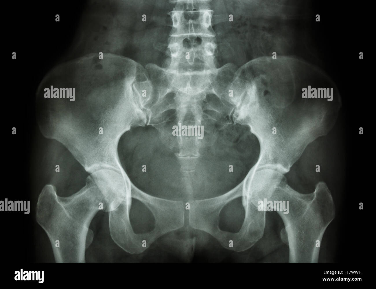 Radiologie du bassin Banque de photographies et d’images à haute ...