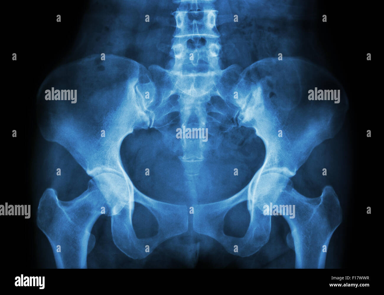 Film X-ray de bassin Banque D'Images