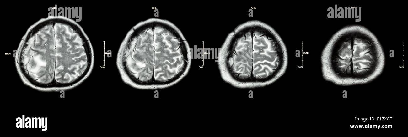 Tumeur au cerveau ( Film Scanner de cerveau : montrent une partie de la  tumeur au cerveau Photo Stock - Alamy