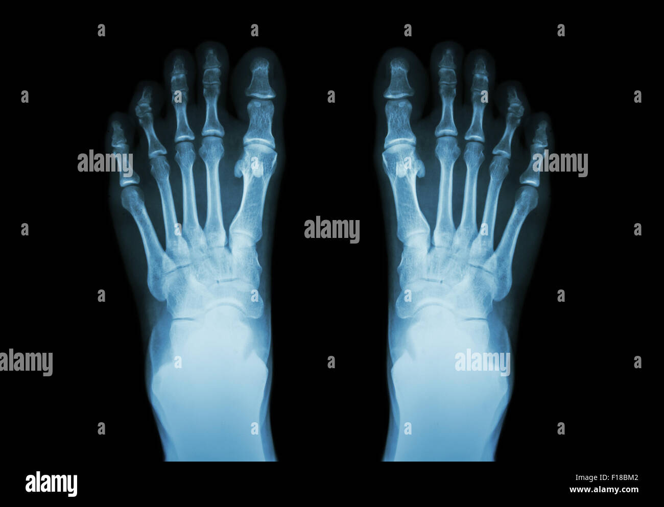 Film x-ray les deux pieds ( vue avant ) Banque D'Images