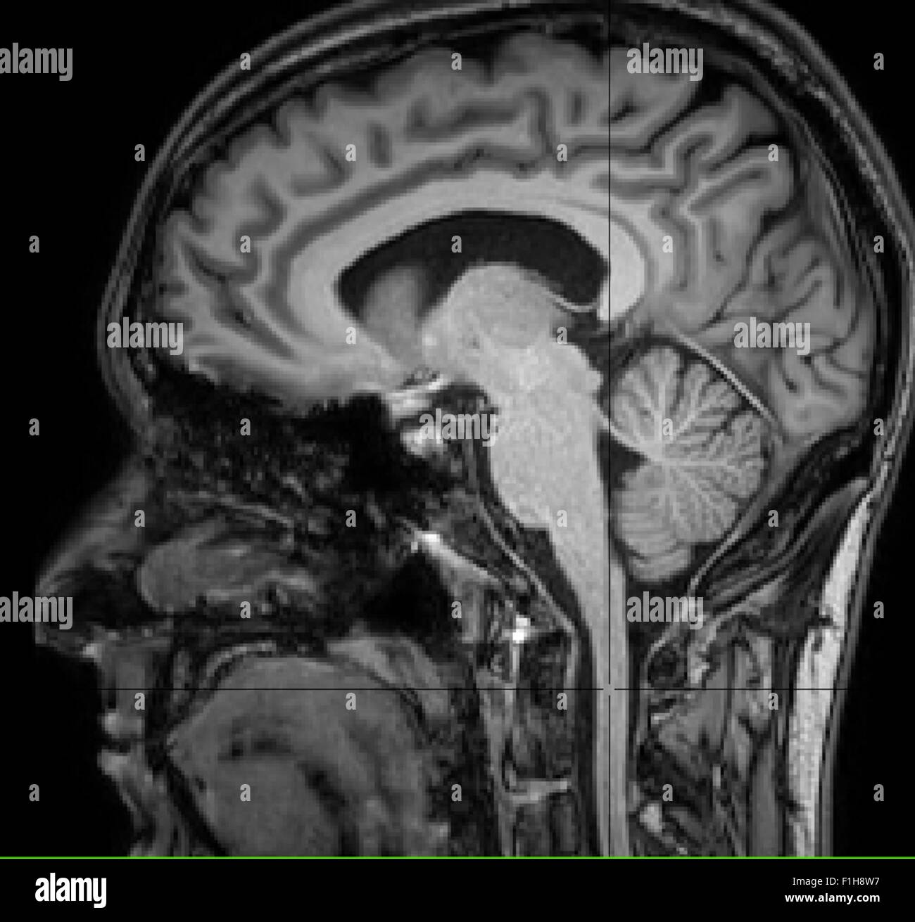 Vue sagittale du cerveau et de la moelle épinière sur un T1 libre Banque D'Images