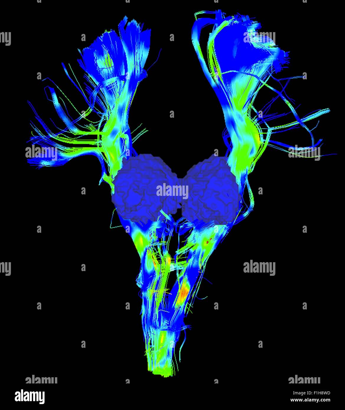 Spinal corticale intestinal, grand lot dans le système moteur et le thalamus, surface en bleu, dans un cerveau de Parkinson Banque D'Images