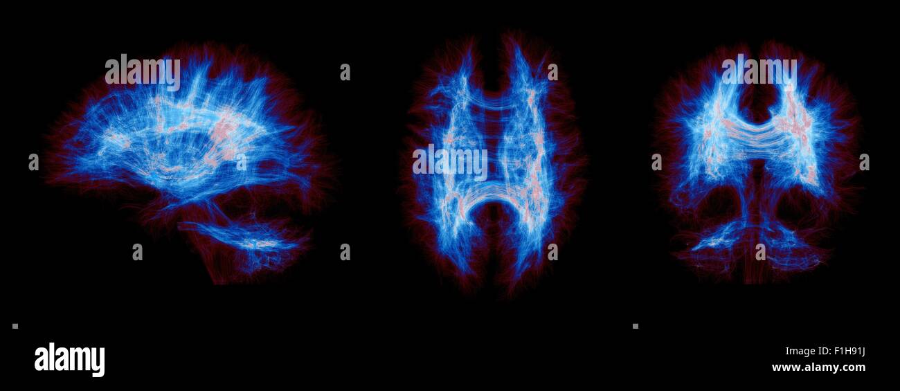Sagittal, Axial, Coronal vues d'un cerveau complet des connexions humaines. Les images sont colorées par la densité des fibres Banque D'Images