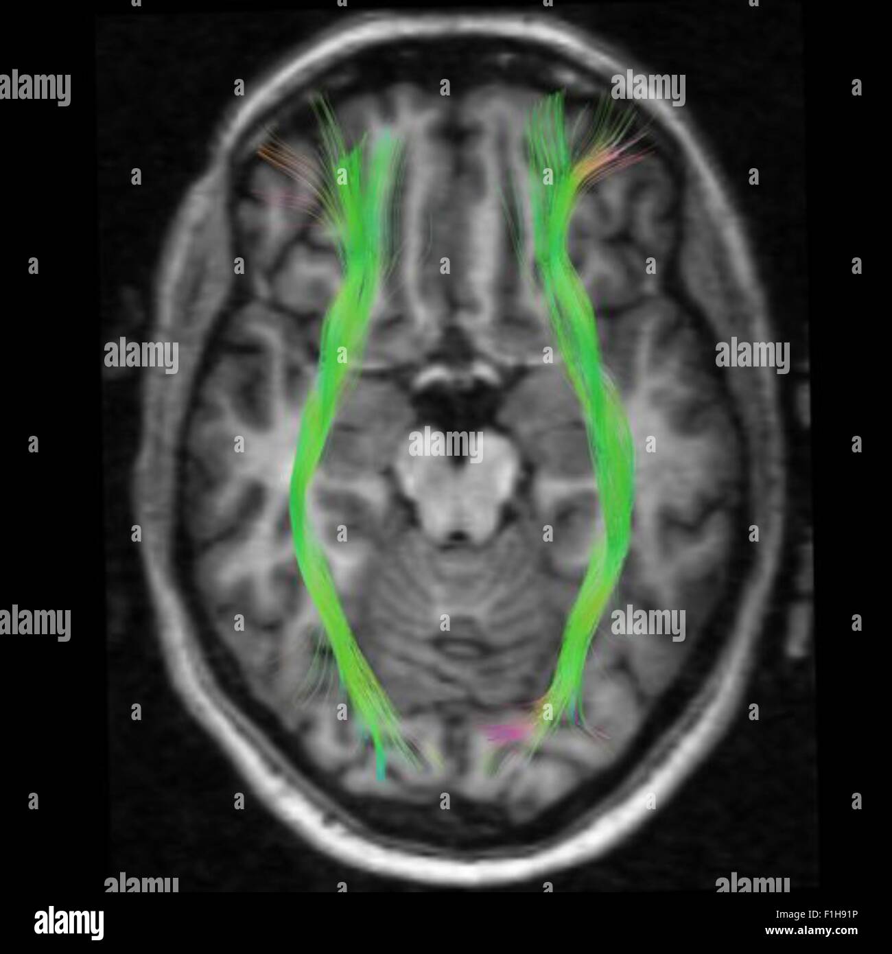 Vue de dessus de la connexions fronto-occipittal, reliant et frontal lobe occipital (vision) Banque D'Images
