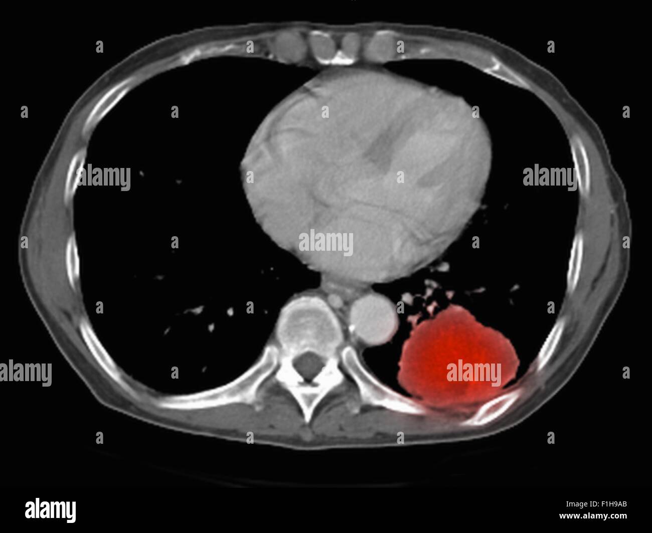 Droit d'inscription co-PET-CT scanner modalité double étude. Plusieurs patients des lésions métastatiques pulmonaires et hépatiques Banque D'Images