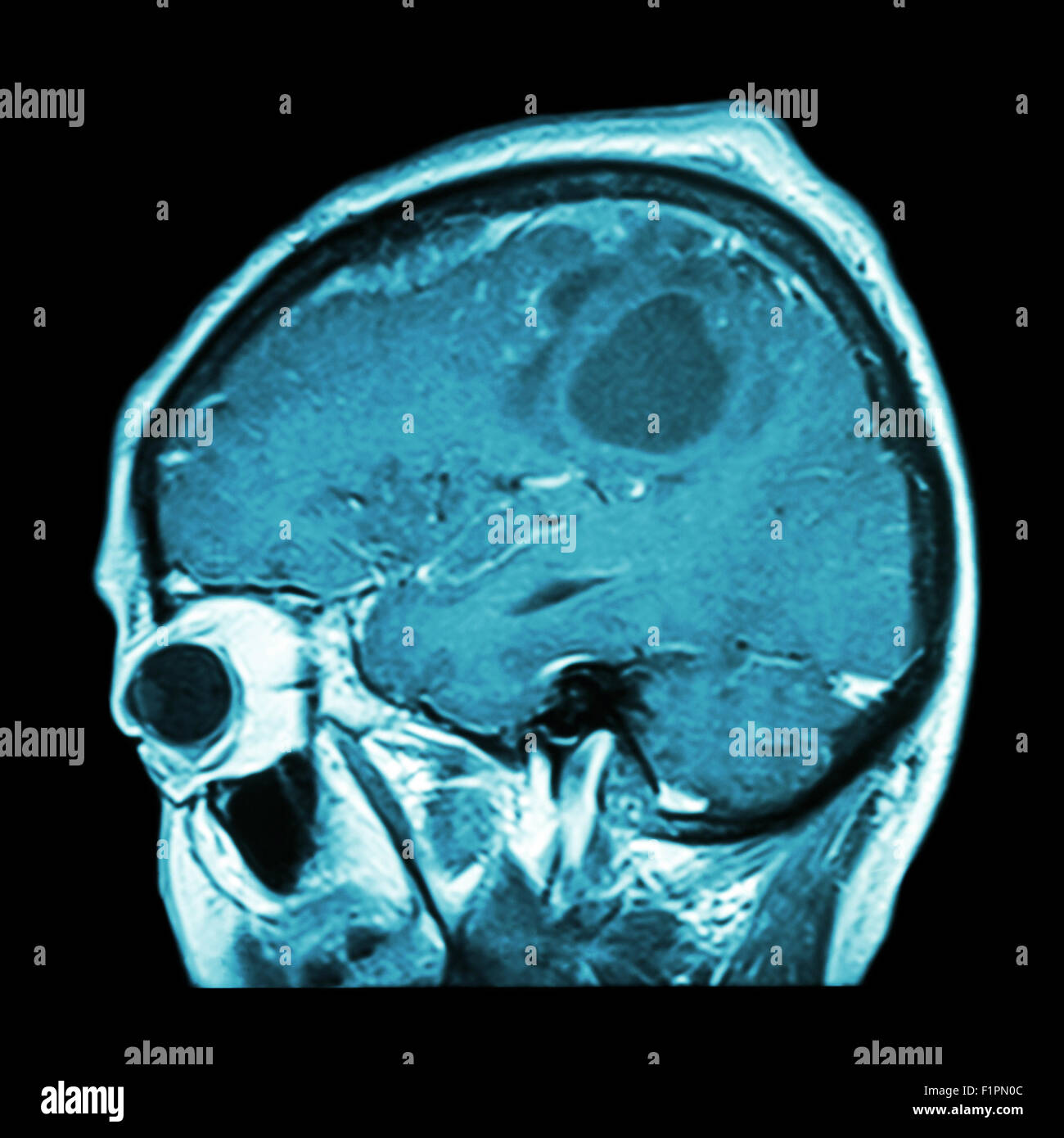 L'IRM cérébrale avec film de tumeur au cerveau ( plan sagittal , , Vue latérale Vue latérale ) ( Medical , soins de santé , Sciences ) Banque D'Images