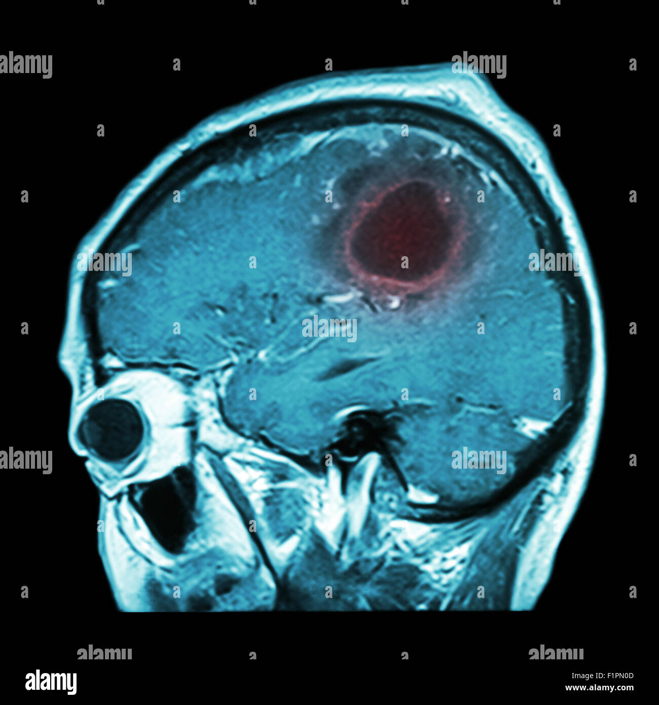 L'IRM cérébrale avec film de tumeur au cerveau ( plan sagittal , , Vue latérale Vue latérale ) ( Medical , soins de santé , Sciences ) Banque D'Images