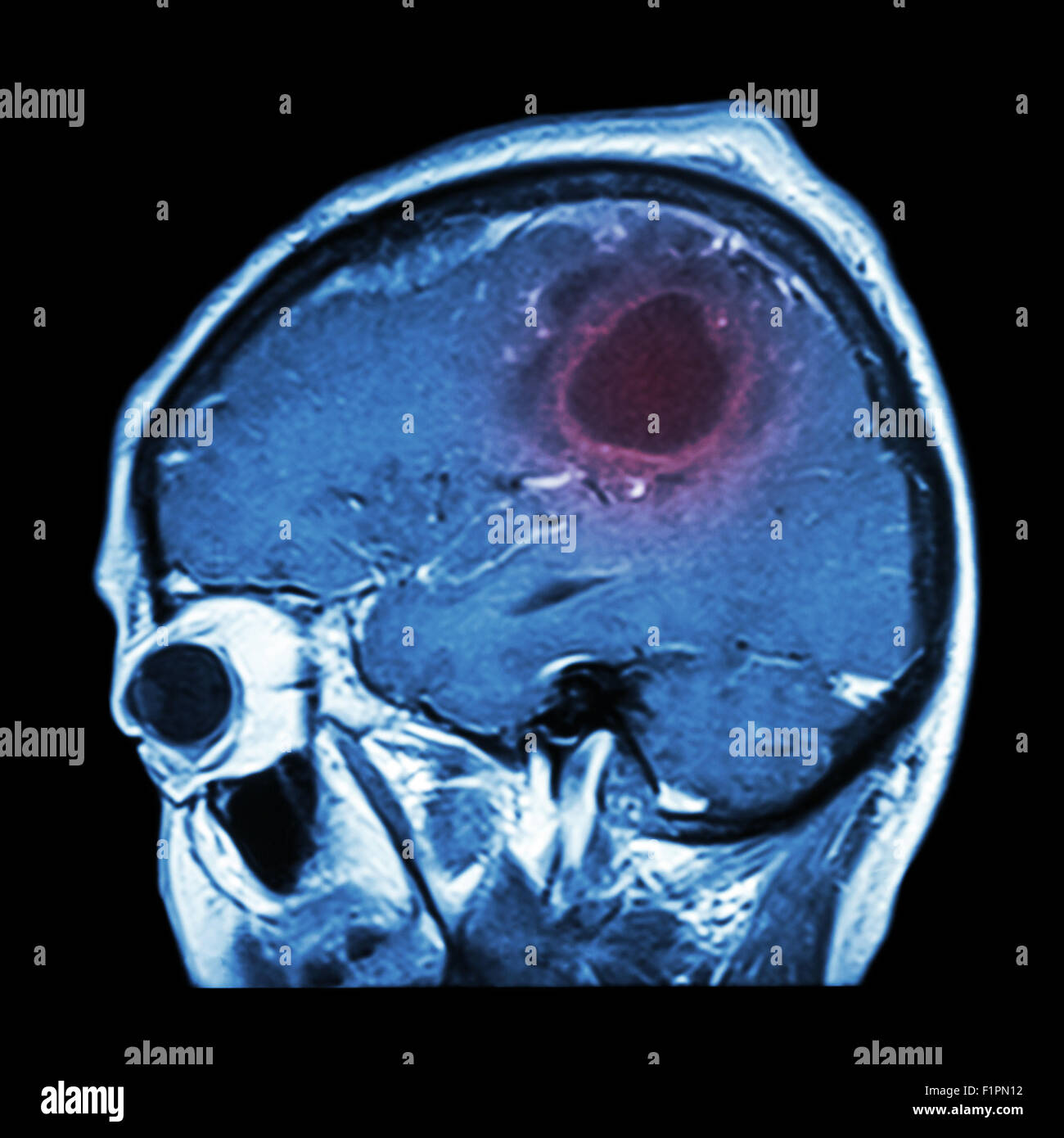 L'IRM cérébrale avec film de tumeur au cerveau ( plan sagittal , , Vue latérale Vue latérale ) ( Medical , soins de santé , Sciences ) Banque D'Images