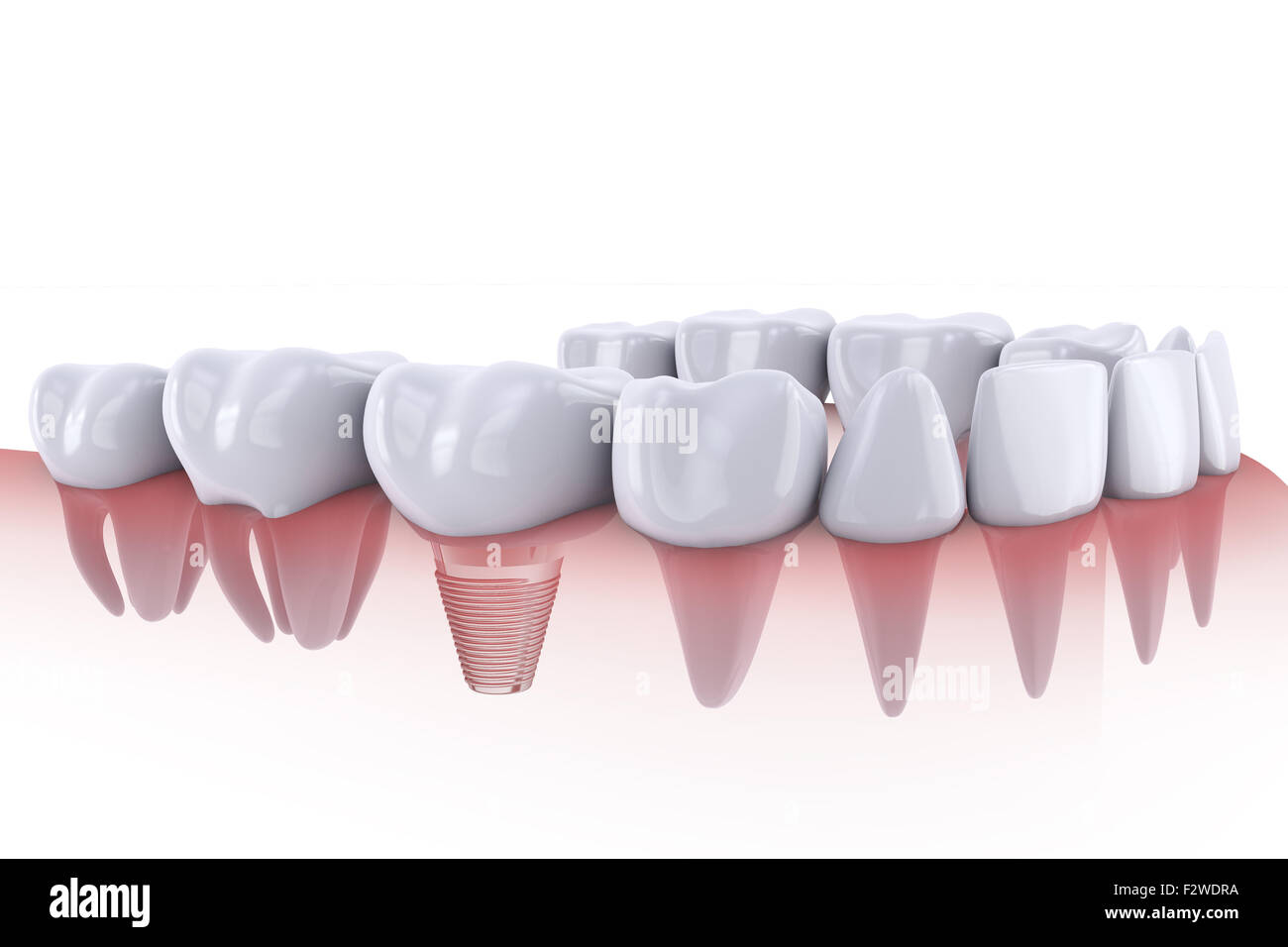 Un implant dentaire dents et de rendu 3D Banque D'Images