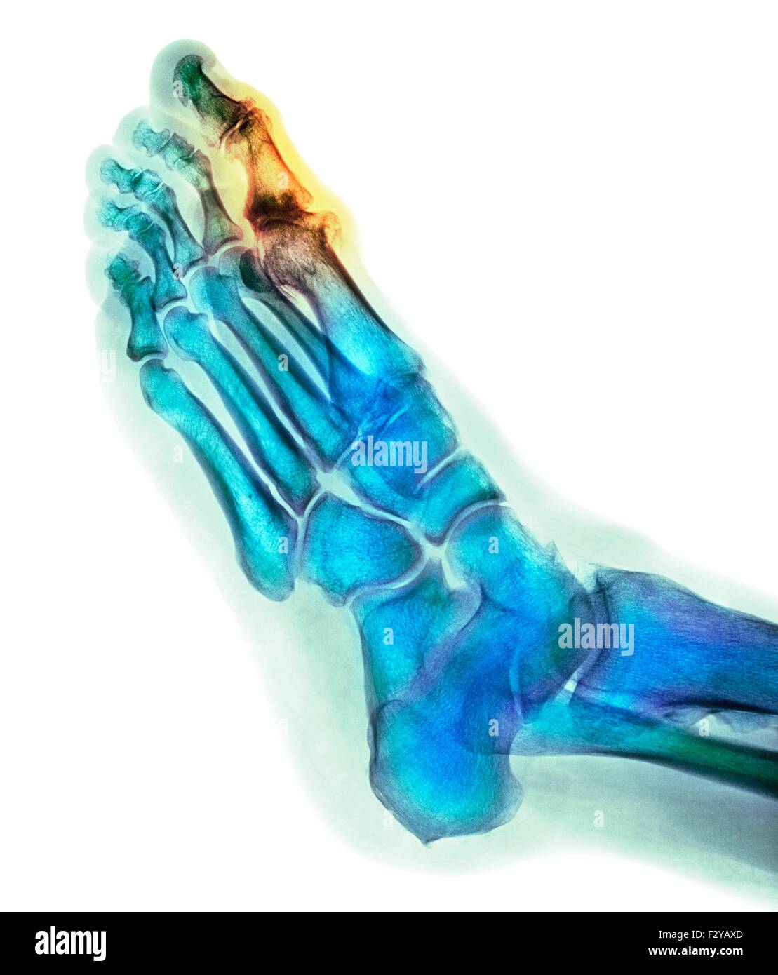 Déformation du pied dégénératives. X-ray de couleur d'une section à travers le pied d'un 66-year-old male patient souffrant d'une grave maladie dégénérative changement de l'articulation métatarsophalangienne (MTP) joint (en surbrillance) du gros orteil (haut). Les joints du PSG sont les articulations entre les métatarses du pied et la partie proximale de l'os (phalanges proximales) des orteils. Banque D'Images