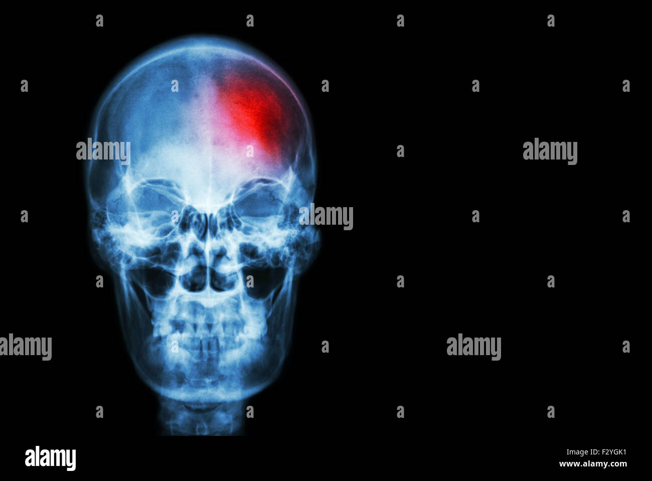 L'accident vasculaire cérébral ( AVC ) . film x-ray de crâne humain avec zone rouge ( Medical , la science et les soins de concept et bac Banque D'Images