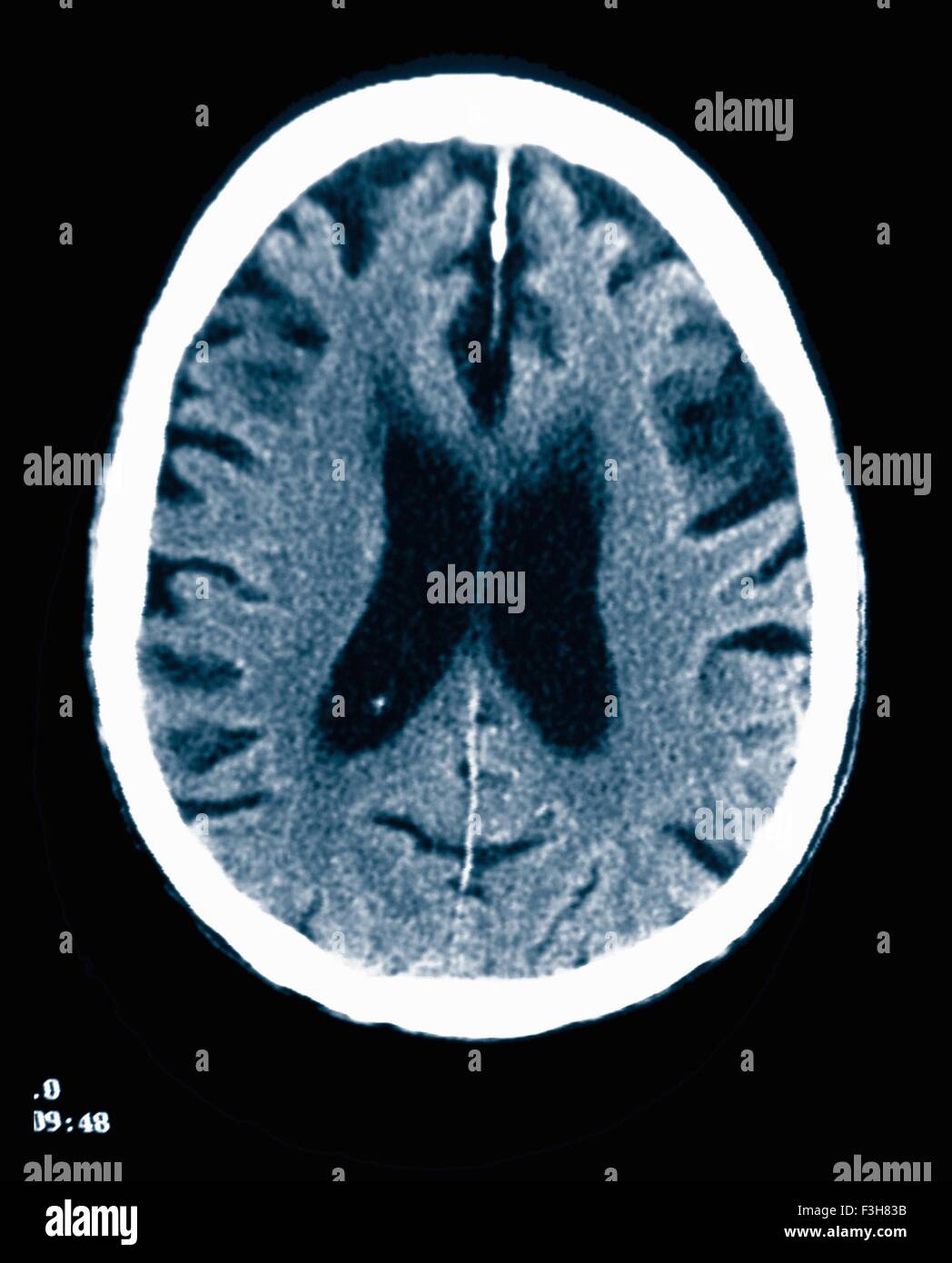 CT scan 84 ans homme à la maladie d'Alzheimer. La TDM montre l'atrophie du cerveau avec de petites et grandes circonvolutions sulci Banque D'Images