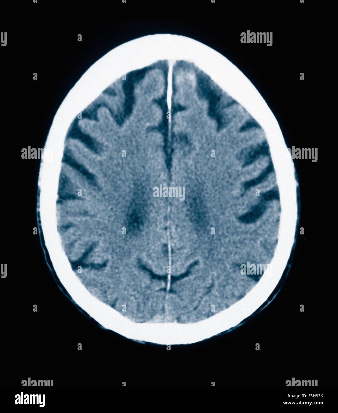 CT scan 84 ans homme à la maladie d'Alzheimer. La TDM montre l'atrophie du cerveau avec de petites et grandes circonvolutions sulci Banque D'Images