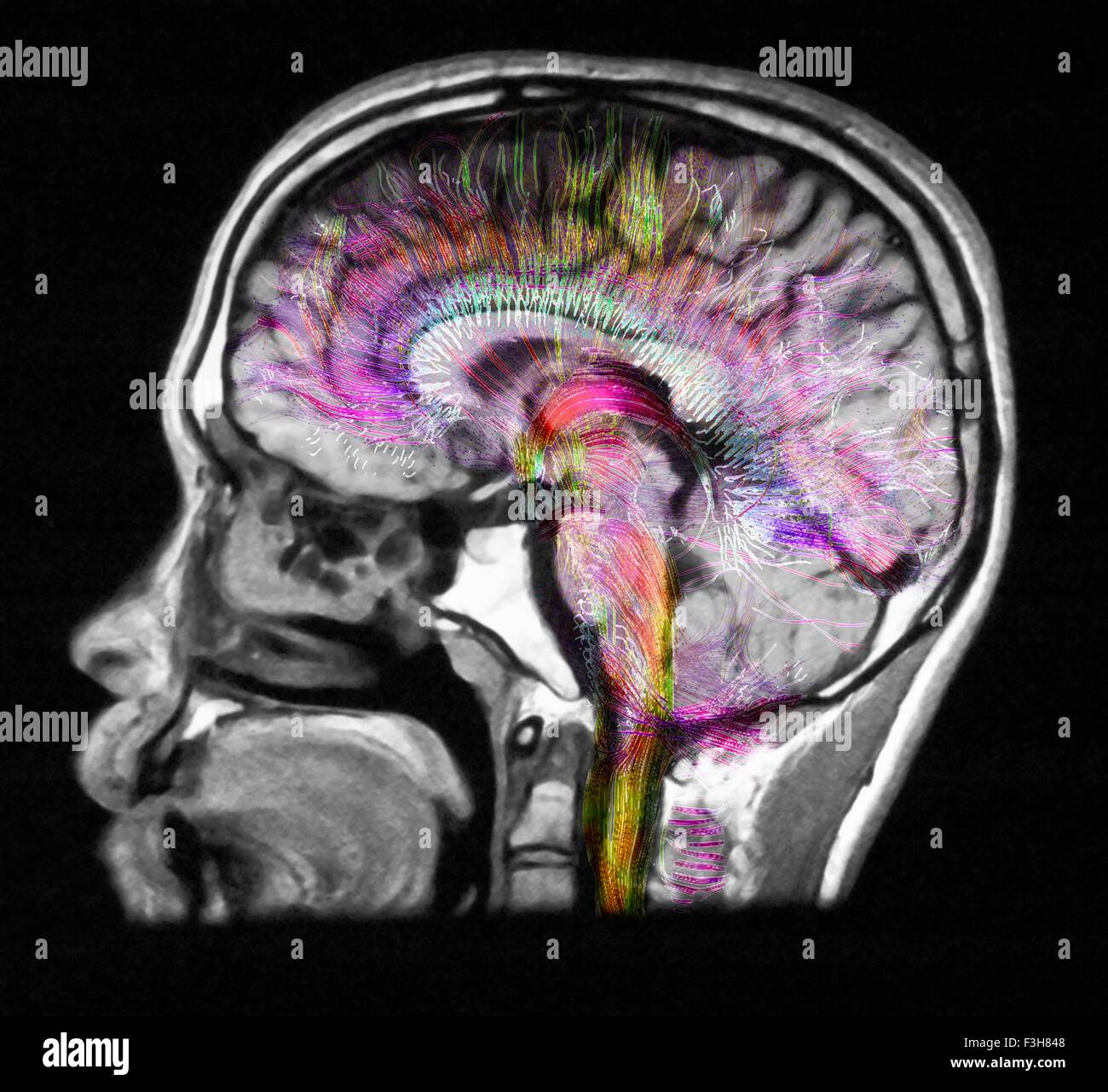 L'IRM de diffusion, également appelé l'imagerie du tenseur de diffusion ou DTI, du cerveau humain Banque D'Images