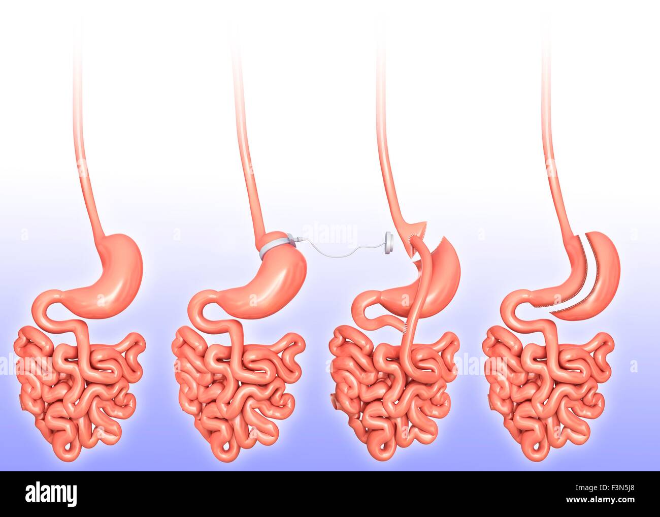 La chirurgie de perte de poids, illustration Banque D'Images