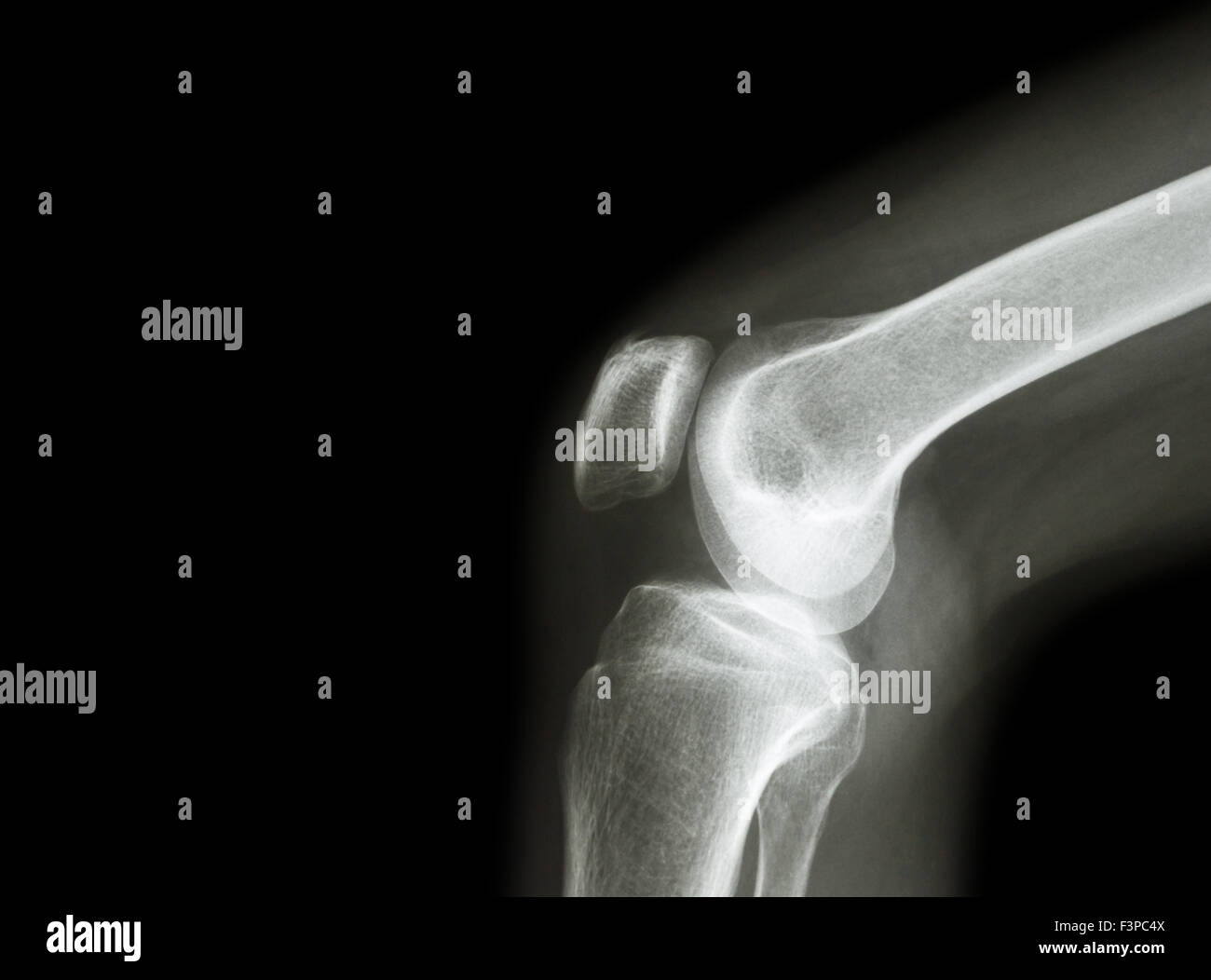 Film x-ray articulation du genou avec l'arthrite ( la goutte, l'arthrite rhumatoïde, l'arthrite septique , l'arthrose du genou ) et la zone vide sous Banque D'Images