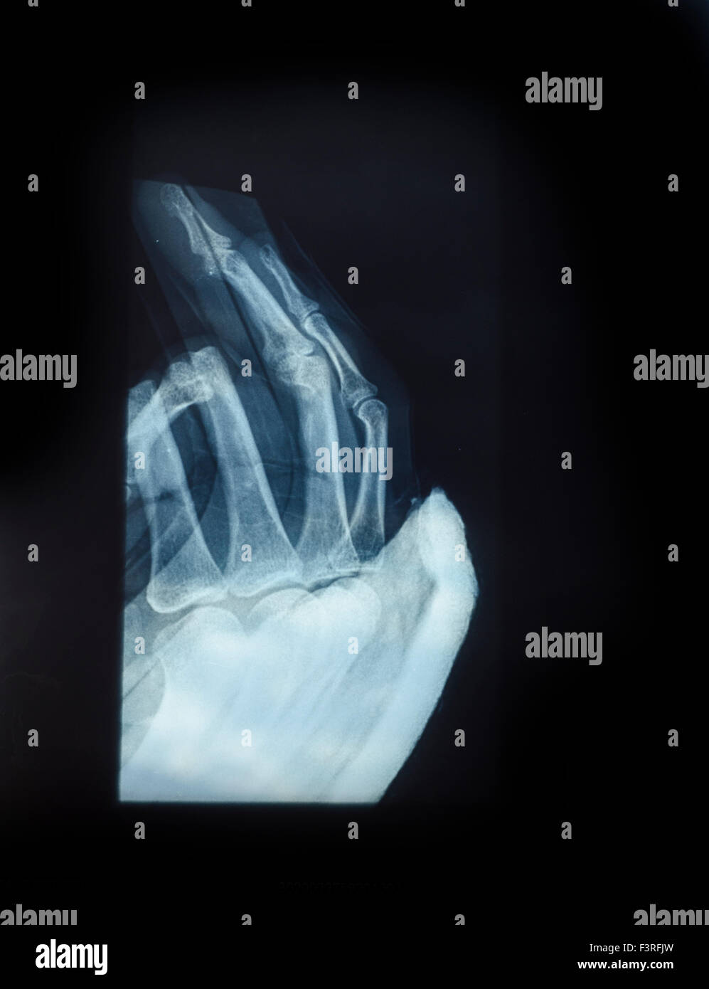 X-ray image de main humaine de fractures Banque D'Images