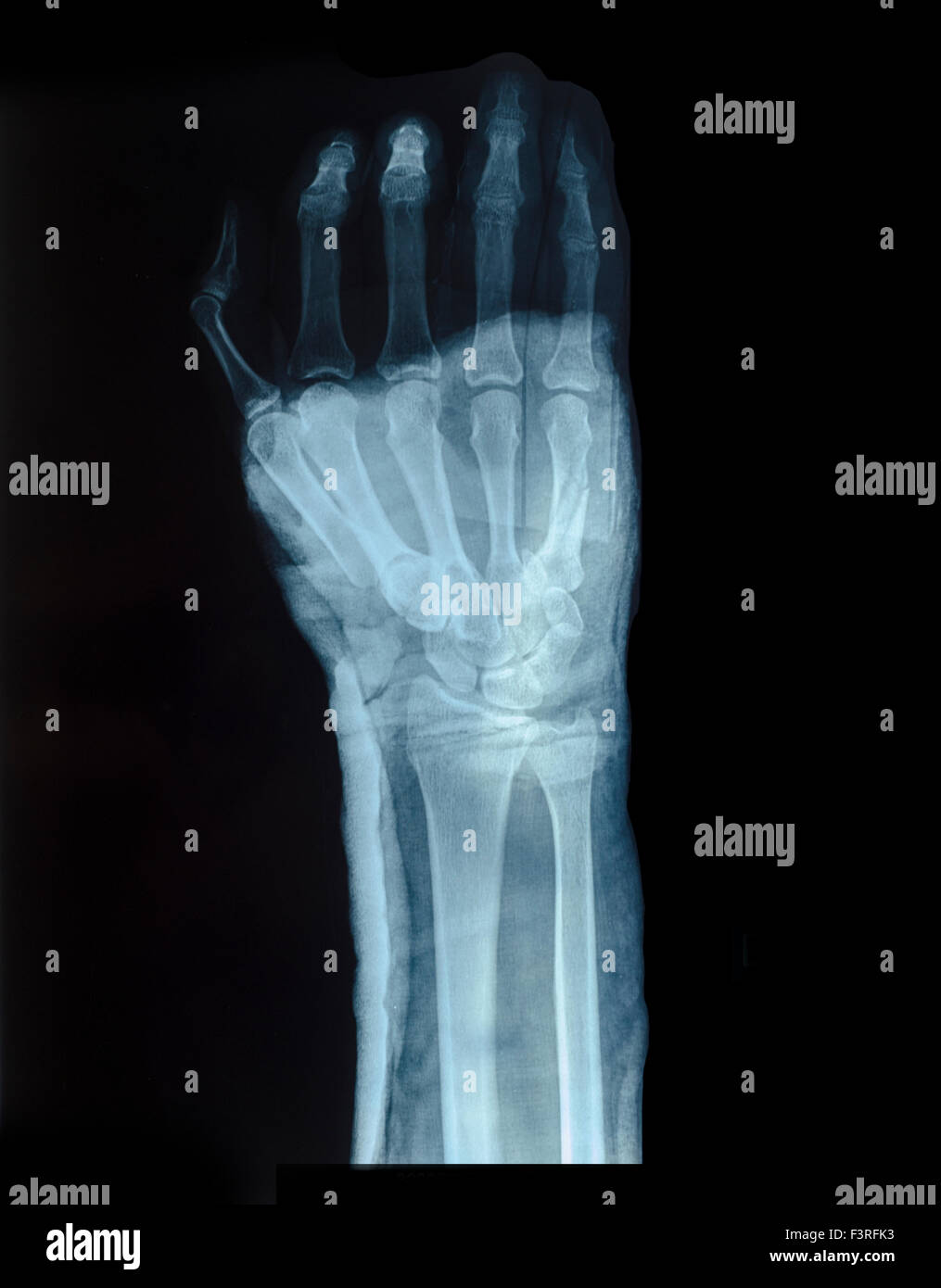 X-ray image de main humaine de fractures Banque D'Images