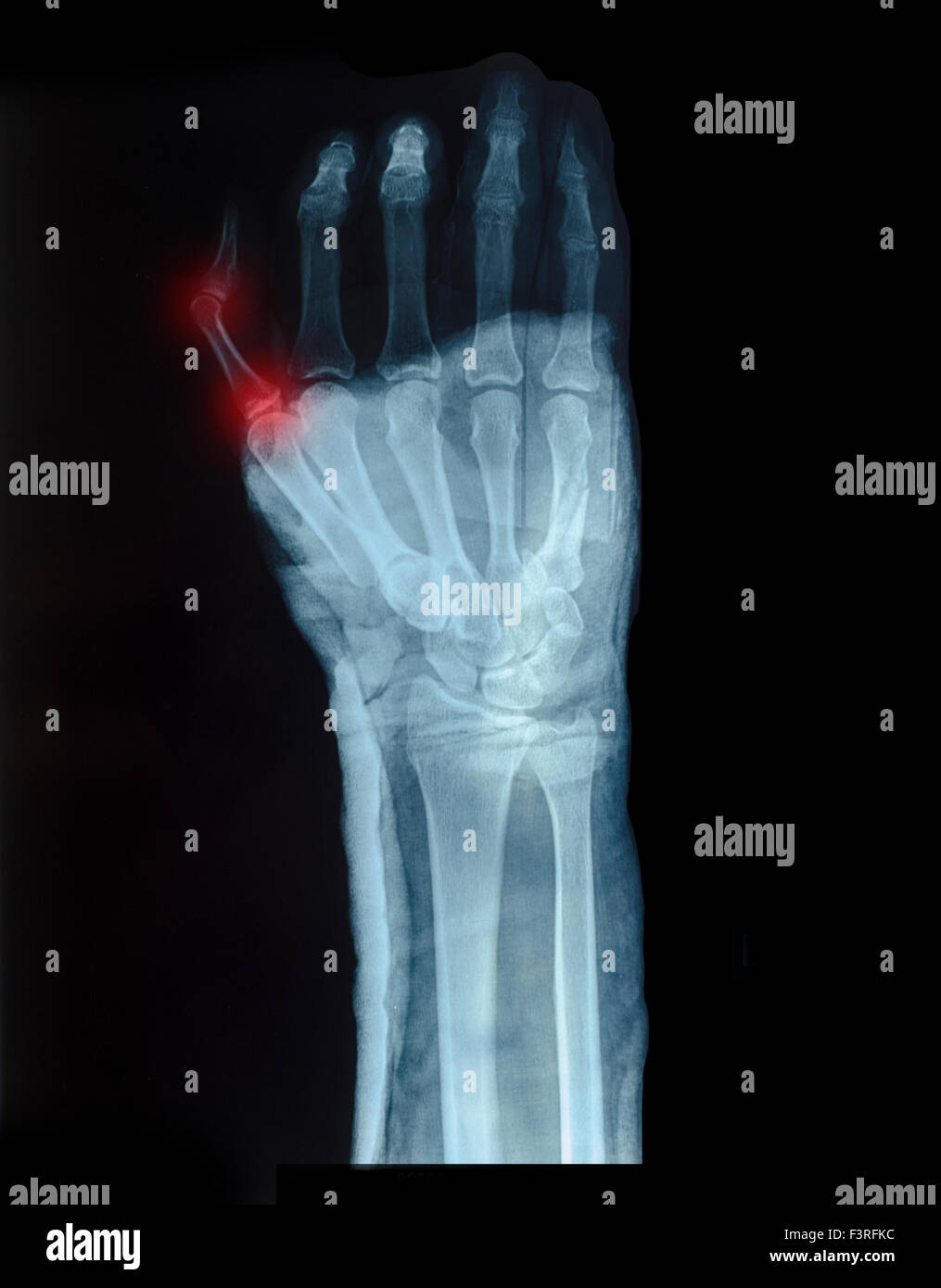 X-ray image de main humaine avec de petits doigts montré de fracture rouge Banque D'Images