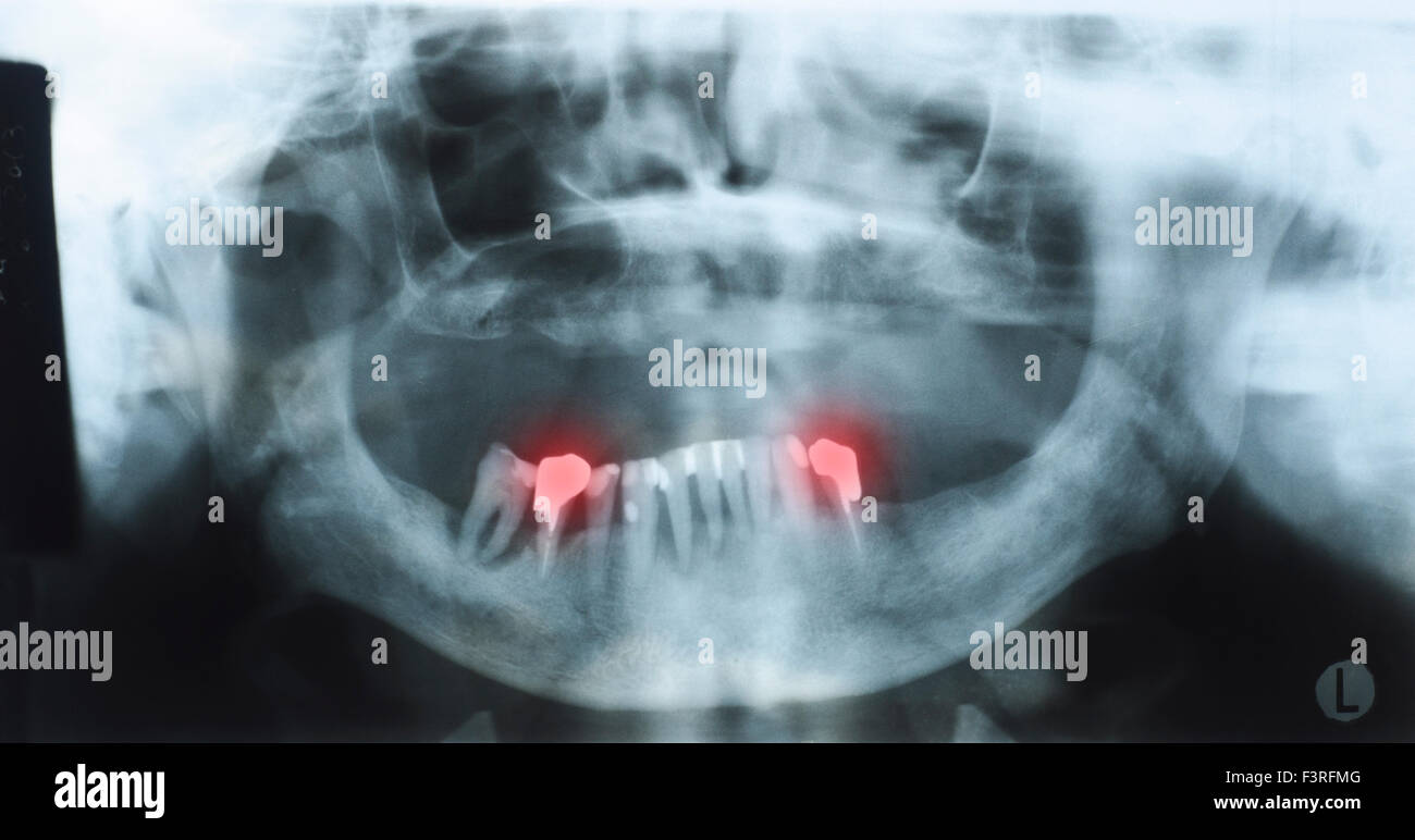La radiographie dentaire panoramique d'une vieille personne avec quelques dents inférieures et aucune dent de la partie supérieure. Prothèse illustré rouge. Sélection Banque D'Images